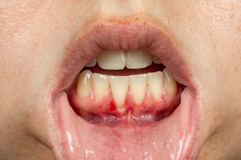 Waarom is parodontale nazorg zo belangrijk?